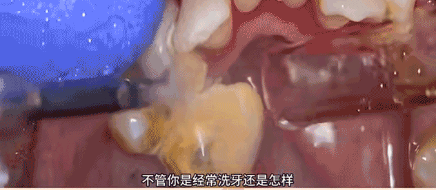 图片来源：b站“牙医A中国牙骑士”